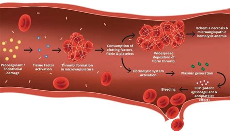 disseminated intravascular coagulation image.